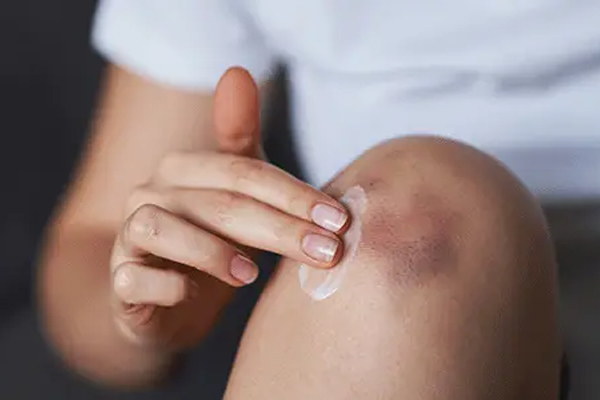 کبودی بدن بعد از ورزش