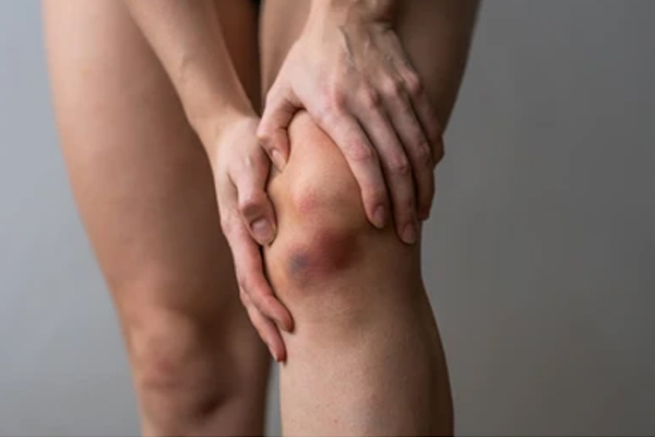 بهترین روشهای درمان کبودی بدن بعد از ورزش