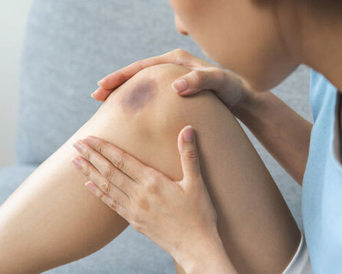 بهترین روش‌های درمان کبودی بدن بعد از ورزش