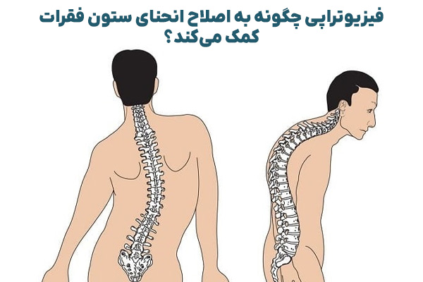 فیزیوتراپی چگونه به اصلاح انحنای ستون فقرات کمک میکند؟